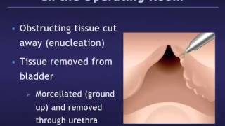 Holmium Laser Enucleation of the Prostate HoLEP for Benign Prostatic Hyperplasia BPH [upl. by Weatherley]