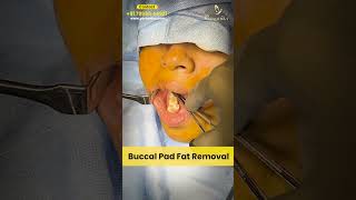 Experience Buccal Fat Removal Surgery by Dr Guru Karna Vemula at Personiks  shortsfeed shorts [upl. by Nereen]