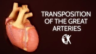 Transposition of the Great Arteries [upl. by Romy]