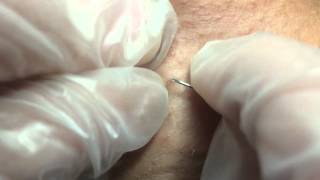 Releasing an Ingrown Hair [upl. by Tnahsin]