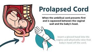 Pregnancy amp Delivery Emergencies in EMS [upl. by Ellednek]