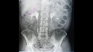 BANGLA TECHNIQUE OF IVUINTARVENOUS UROGRAMPROCEDURES OF IVU TEST [upl. by Duvall]