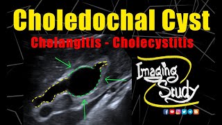 Choledochal Cyst with Cholangitis amp cholecystitis  Ultrasound  Case 272 [upl. by Marjana]