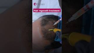 Hair regrowth Treatment  hairloss hairfall [upl. by Bouchard]