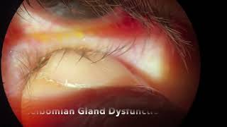 Disfunción de glándulas de Meibomio  Meibomian gland dysfuntion [upl. by Eadrahs375]