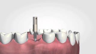 Osstell ISQ the only objective way to measure implant stability HD [upl. by Nyletac8]