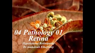 04 Retinal Pathology 01 Elkafrawy pathology باثولوجي الكفراوي Hypertensive Retinopathy [upl. by Freudberg]