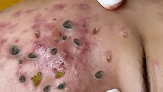 Big Cystic Acne Blackheads Extraction Blackheads amp Milia Whiteheads Removal Pimple Popping [upl. by Etra596]