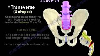 Sacral Fractures  Review  Everything You Need To Know  Dr Nabil Ebraheim [upl. by Arinaj]