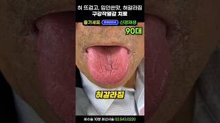 혀뜨거움 혓바닥 갈라짐 입안쓴맛과 구강작열감 치료 구함증치료 혀아플때 안면신경 3차신경통치료 [upl. by Kyle191]