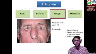 Ectropion Basics to Surgical aspects [upl. by Curr288]