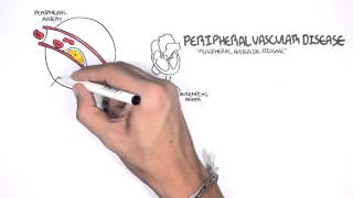 Cardiovascular Disease Overview [upl. by Anehsuc]