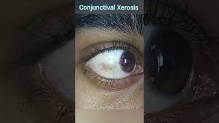 Xerophthalmia  Conjunctival Xerosis  Vitamin A Deficiencies [upl. by Akimrej]