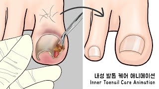 ASMR 시원함 주의 리얼한 내성 발톱 케어 애니메이션  Ingrown Toenail removal treatment animation [upl. by Ellehcim]