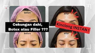 Suntik Botox Before and After DAHI Hasil NYATA  Bikin Awet Muda Ovela Clinic [upl. by Eirlav499]