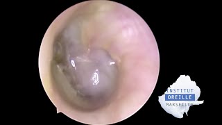 Perforated Purulent Otitis Media  Otite moyenne purulente perforée [upl. by Ecerahc]