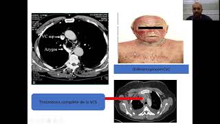 11Cancer bronchique partie 1  Pneumo [upl. by Attennyl41]