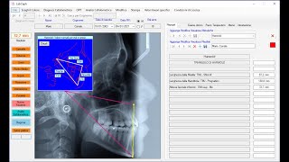 02 Introduzione alla diagnosi cefalometrica [upl. by Derina756]