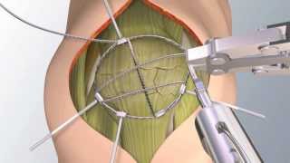 Himawari method for comminuted patellar fractrure [upl. by Campman640]