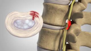 Herniated Disc  Patient Education [upl. by Stultz]