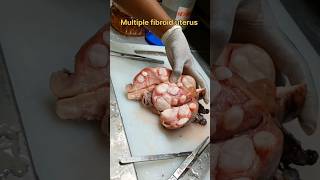 Multiple fibroid uterus specimen [upl. by Tessil177]