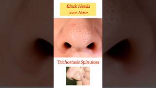 Black Heads amp Hairs over Nose  Trichostasis Spinulosa noseblackheads nosehair blackheads nose [upl. by Temhem]