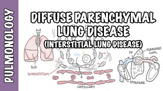 Interstitial Lung Disease ILD  Classification pathophysiology signs and symptoms [upl. by Nnylak273]