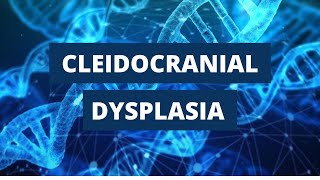 Cleidocranial Dysplasia Introduction Etiology Clinical Features and Treatment [upl. by Eisse256]