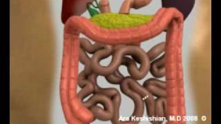 Duodenal Switch operation [upl. by Bouzoun]