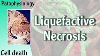 Pathophysiology  Liquefactive Necrosis Hani Laith شرح [upl. by Trebeh]