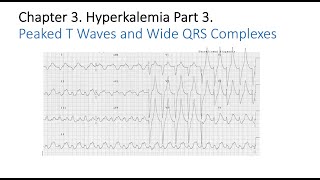 Hyperkalemia Part 3 Symptoms Diagnosis and Complications [upl. by Airrat]