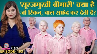 सफेद Skin Hair वाले देखे होंगे पर ये Albinism कौन सी बीमारी है किसे हो सकती है  Sehat ep 193 [upl. by Ane]