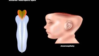 Newborn Exam by N Gold  OPENPediatrics [upl. by Ayrolg]