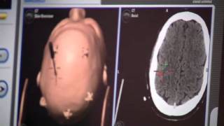 AutoLITT  A Minimally Invasive Brain Tumor Treatment [upl. by Nhoj967]