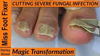 Fungal Nail Treatment Magical Transformation by Miss Foot Fixer Marion Yau [upl. by Asirral]