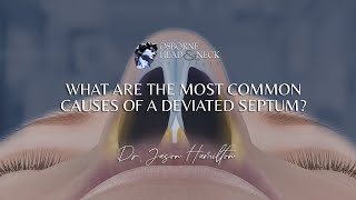 What are the most common causes of a deviated septum [upl. by Beebe]