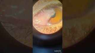 Pterygium  pterygium eyediseases [upl. by Claretta507]