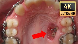 💝 HOW BRACES WORK Amazing Transpositions in 4K  Before and After [upl. by Lesya]