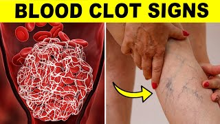 Warning Signs Of A Blood Clot That Can’t Be Ignored [upl. by Yanat193]