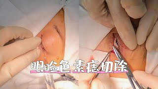 【眼球微恐怖慎入！】下睑缘色素痣切除！plasticsurgeon 高能 moles [upl. by Atiuqat]