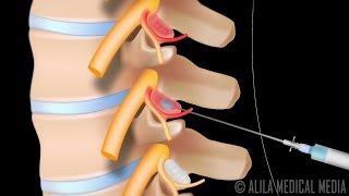 Lumbar Facet Joint Injection Procedure Animation [upl. by Idok]