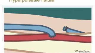 Physical Examination of Arteriovenous Fistula [upl. by Mun362]