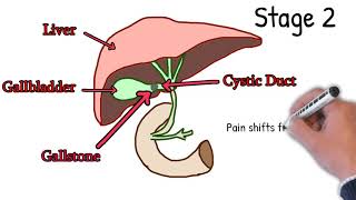 Cholecystitis  Symptoms Causes Treatment How to Detect Cholecystitis Merphy sign Explained Easy [upl. by Mcnamee]