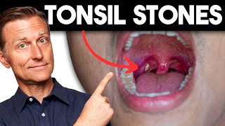 Tonsil Stones Removing the Deeper Cause [upl. by Ardnoet]