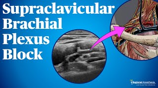 Supraclavicular Brachial Plexus Block [upl. by Colvin]