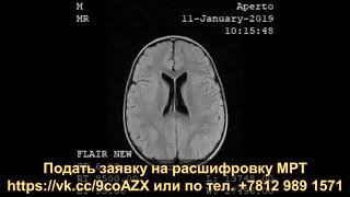 Расшифровка МРТ головного мозга РЕБЕНКУ 35 ЛЕТ с признаками ЛИССЭНЦЕФАЛИИ и пахигирии [upl. by Turrell]