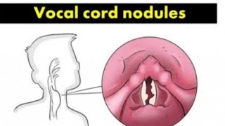 R45 Dr receweg for Hoarseness voicetreatment in homeopathymedicircle7553 [upl. by Sairacaz664]