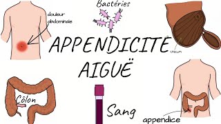 LAPPENDICITE AIGUË physiopathologie symptômes diagnostic traitement [upl. by Dieter]