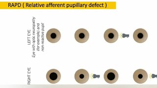 Relative afferent pupillary defect  RAPD  explained [upl. by Jempty]