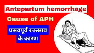 Antepartum hemorrhage in hindi  APH in pregnancy  cause of aph [upl. by Urania]